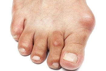 Bunions Treatment and Surgery in the Cobb County, GA: Atlanta (Sandy Springs, Vinings, Smyrna, Powers Park, East Cobb, Chattahoochee Plantation, Fair Oaks, Mableton, Brookhaven, Dunwoody, Buckhead, Chamblee) and Cherokee County, GA: Woodstock (Oak Grove, Sixes, Holly Springs, Hickory Flat, Willow Tree, Tomahawk, Mountain Park, Canton, Vandiver Heights, Willow Creek, Noonday, Marietta) areas