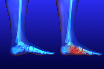Flat feet and Fallen Arches treatment in the Cobb County, GA: Atlanta (Sandy Springs, Vinings, Smyrna, Powers Park, East Cobb, Chattahoochee Plantation, Fair Oaks, Mableton, Brookhaven, Dunwoody, Buckhead, Chamblee) and Cherokee County, GA: Woodstock (Oak Grove, Sixes, Holly Springs, Hickory Flat, Willow Tree, Tomahawk, Mountain Park, Canton, Vandiver Heights, Willow Creek, Noonday, Marietta) areas