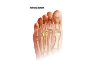 A Possible Cause of Morton’s Neuroma