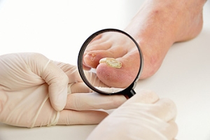 Common Signs of Toenail Fungus